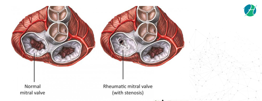 Rheumatic Heart Disease Healthsoul