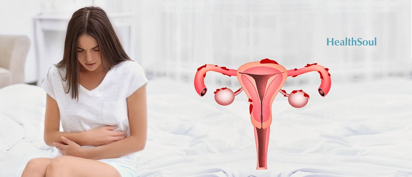 All-Natural Ways to Treat Endometriosis Pain | HealthSoul
