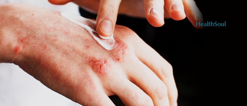 Four Ways to Treat Eczema at Home | HealthSoul