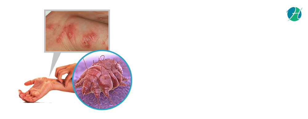 Scabies Diagnosis And Treatment Healthsoul 1099
