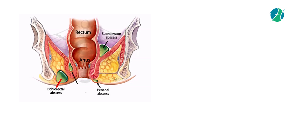 Anorectal Abscess: Causes, Risk factors and Treatment | HealthSoul
