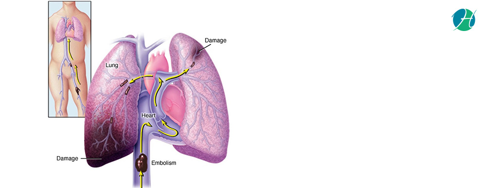 Pulmonary Embolism: Causes, Symptoms and Treatment | HealthSoul