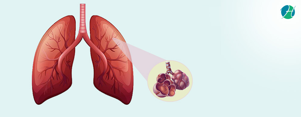 Pulmonary Fibrosis: Causes, Symptoms and Treatment – Healthsoul