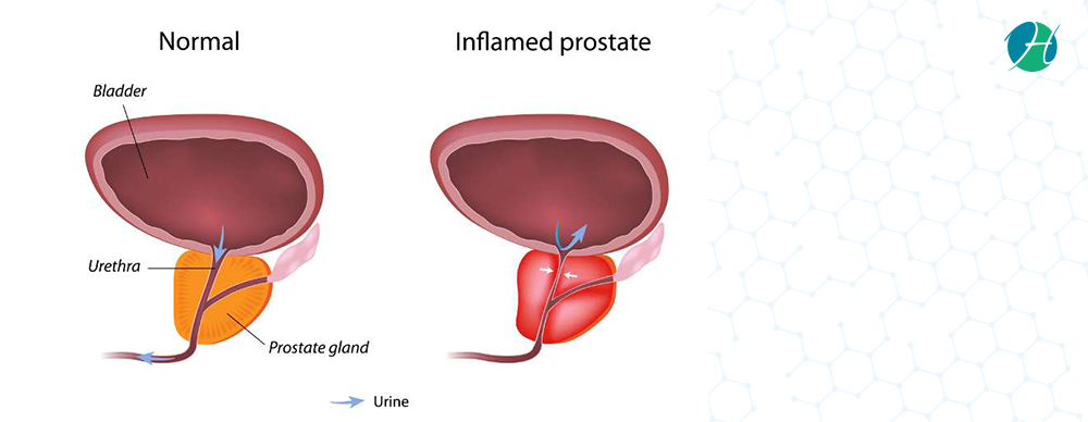 Prostatitis: Symptoms, Diagnosis And Treatment – Healthsoul