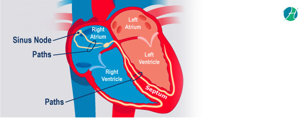Supraventricular Tachycardia: Causes, Symptoms and Treatment | HealthSoul