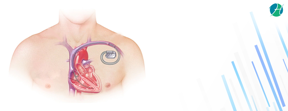 Implantable Cardioverter Defibrillator: Indications and Complications | HealthSoul