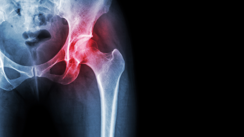 Osteonecrosis: Symptoms and Treatment | HealthSoul