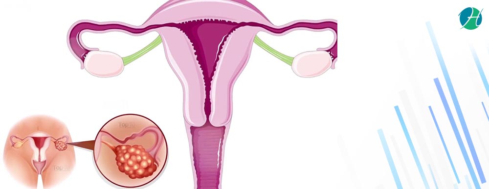 Ovarian Cancer: Screening and Prevention | HealthSoul