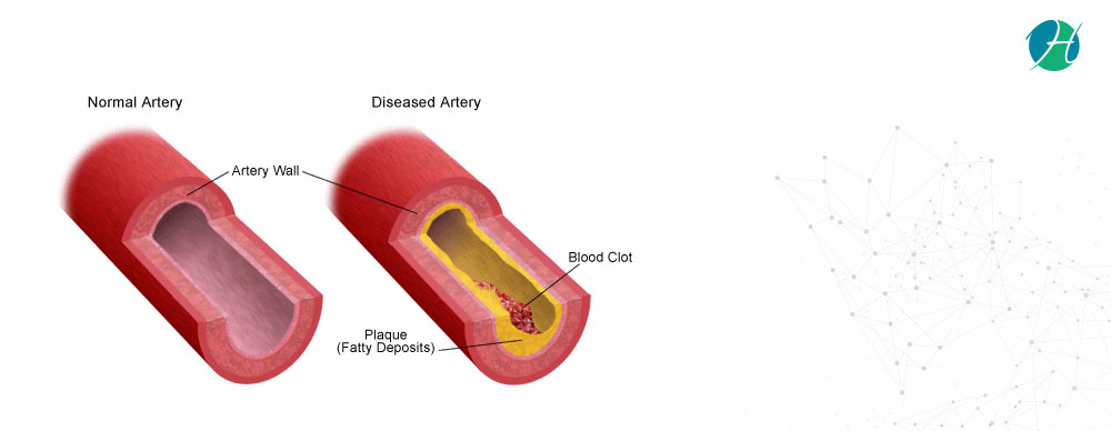Carotid Artery Disease: Causes and Treatment | HealthSoul