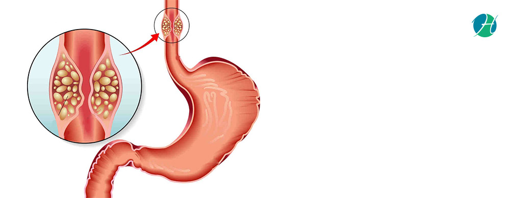 Esophageal Cancer: Symptoms, Diagnosis and Treatment | HealthSoul
