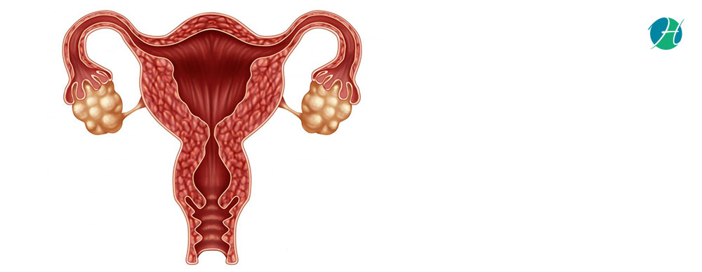 Oophorectomy: Indications and Complications | HealthSoul