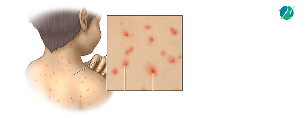 Chickenpox: Symptoms and Treatment | HealthSoul