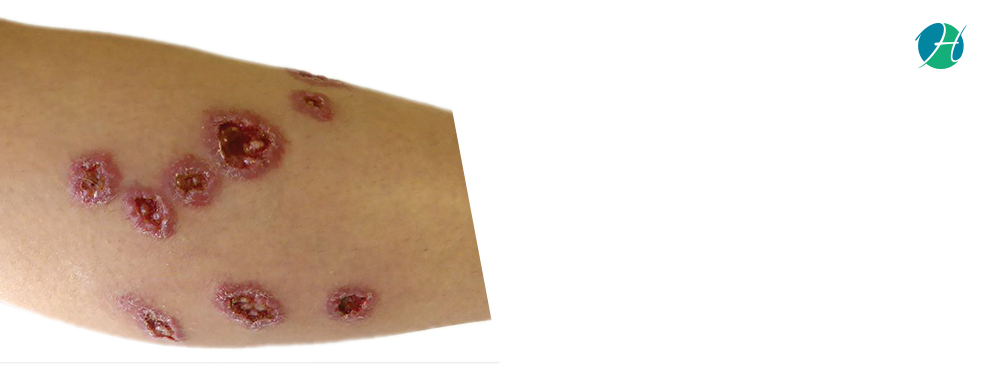 Leishmaniasis: Symptoms and Treatment | HealthSoul