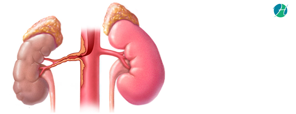Renal Artery Stenting : Indications and Complications | HealthSoul