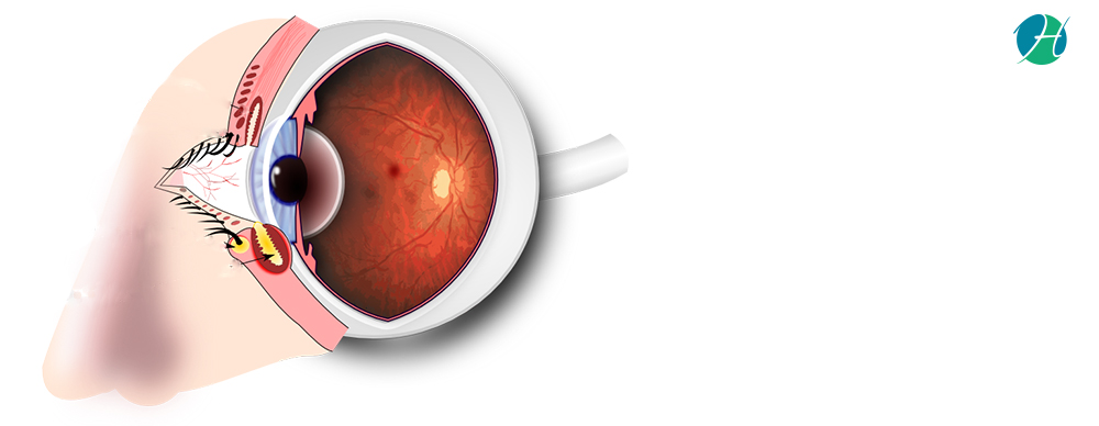 Stye : Causes and Treatment | HealthSoul