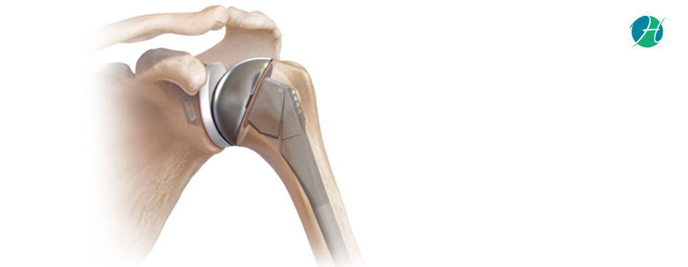 Total Shoulder Arthroplasty: Learn About the Procedure! | HealthSoul