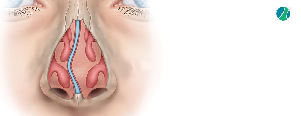 Deviated Nasal Septum: Causes and Treatment | HealthSoul