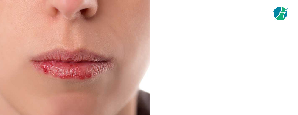 Lip Cancer: Causes, Symptoms and Treatment | HealthSoul
