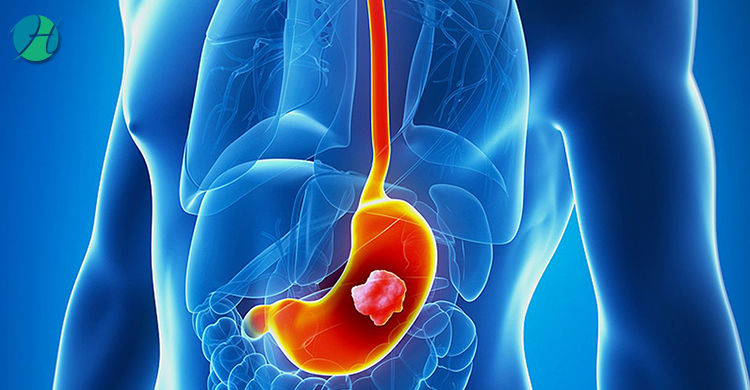 Stomach Cancer | HealthSoul