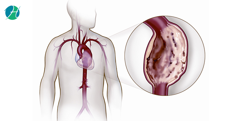 Thoracic Aortic Aneurysm | HealthSoul