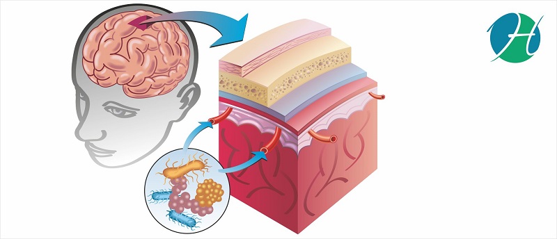 Aseptic Meningitis: Overview, Symptoms, Causes, Diagnosis and Management | HealthSoul