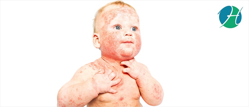 Dermatitis: overview, causes, symptoms, diagnosis and management | HealthSoul