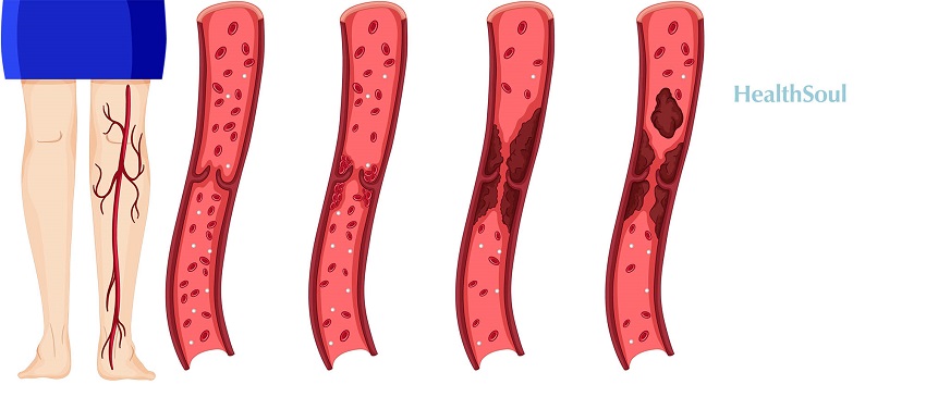 Factor V Leiden: Symptoms, Causes, and Treatment | HealthSoul